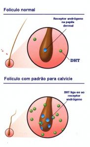 calvicie inicio.jpg